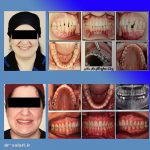 Dr Salari Before After 6 - کلینیک دندانپزشکی دکتر سهیل سالاری و دکتر شقایق لوح