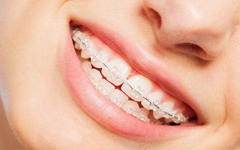 ارتودنسی همرنگ دندان