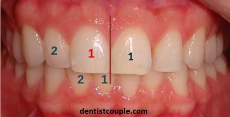 چه کسانی بیشتر به ناهماهنگی خط وسط دندانها یا انحراف میدلاین مبتلا میشوند؟