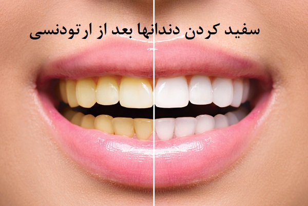 سفید کردن دندانها بعد از ارتودنسی