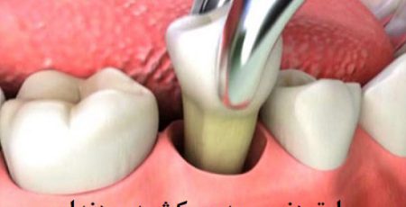 ارتودنسی بدون کشیدن دندان چگونه است؟