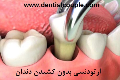 ارتودنسی بدون کشیدن دندان چگونه است؟