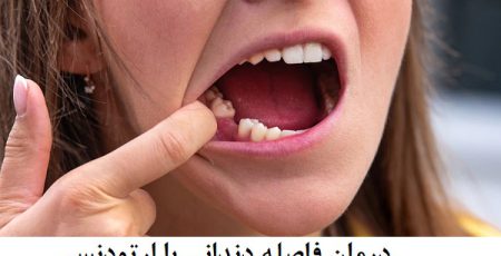 درمان فاصله دندانی با ارتودنسی