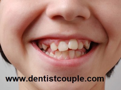 علت کج شدن دندانها در کودکان چیست؟