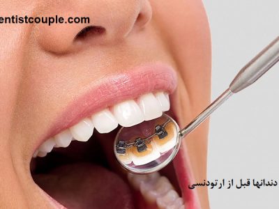 جرم گیری دندانها قبل از ارتودنسی