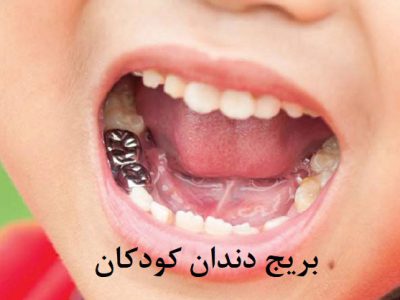 بریج دندان کودکان