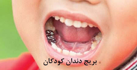 بریج دندان کودکان